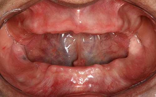 Fig 3 Clínica aspecto del reborde alveolar