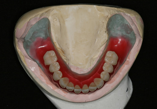 Fig 6 Dientes artificiales mandibulares montados para prueba en cera