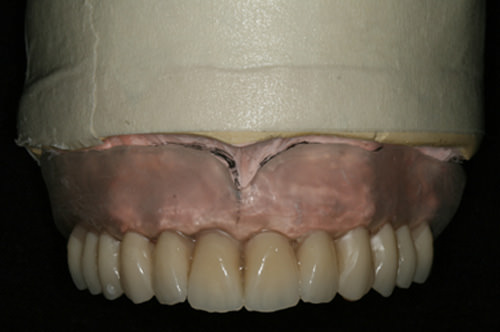 Fig 7 Dientes artificiales de maxilar. Observe que no hay necesidad de rehabilitar el tejido de las encías en la futura prótesis