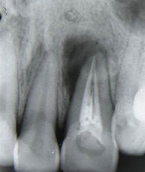 Figura 5 Radiografía de control al primer mes. Proyección ortoradial.