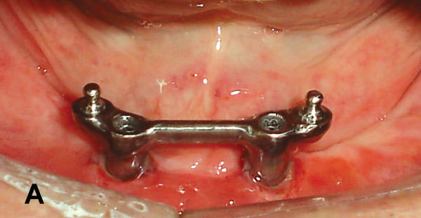 Figura 5A