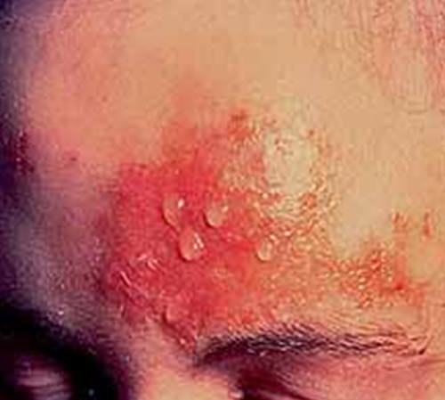 Figura 2 Fotografía clínica: Herpes Zoster.