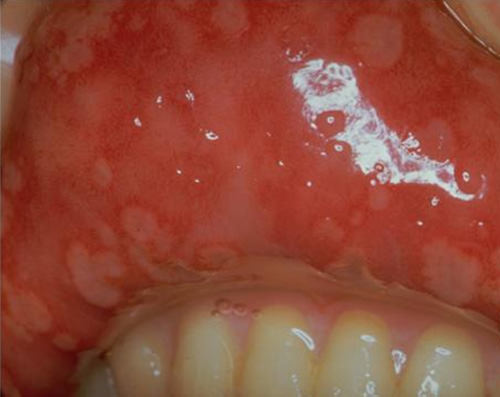 Figura 3 Fotografía clínica: Estomatitis Herpética. Tomadas de medicina clínica 1992 y Rev Eur Odontoestomatol 2004 respectivamente