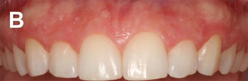 Figura 1.A) Vista frontal de la sonrisa del paciente; B) vista intraoral de los dientes anteriores. Las imágenes evidencian elaspecto de sonrisa gingival con presencia de exostosis y asimetría del margen gingival y dientes cortos.