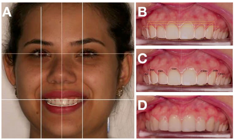 Figura 3. Líneas de referencias para la cara (A) y para cada elemento dental resultante de la planificación digital (B), posibilitando determinar los parámetros para la confección del guía quirúrgico y la medición de la banda de encía que deberá ser removida durante la cirugía (C), además de prever el resultado final del caso (D).