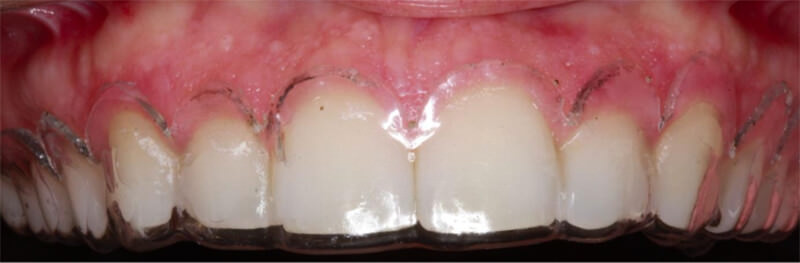 Figura 5. Colocación de la guía quirúrgica después de la colocación de la anestesia, se visualiza el posicionamiento de la guía y la definición del límite cervical de referencia para la realización de la incisión del tejido gingival.