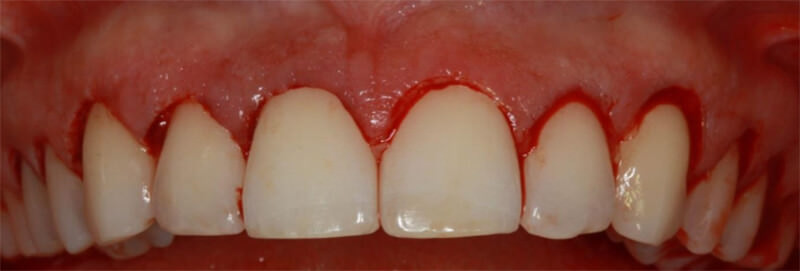 Figura 7. Aspecto del tejido gingival después de la segunda incisión intrasurcular y retiro del collarín gingival