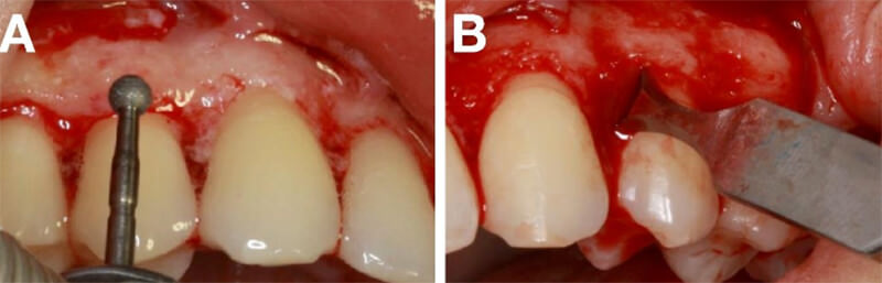 Figura 10.Remocion de tejido oseo con ayuda de limas, cinceles y pieza de alta rotación que permite el proceso de osteotomía y osteoplastia.