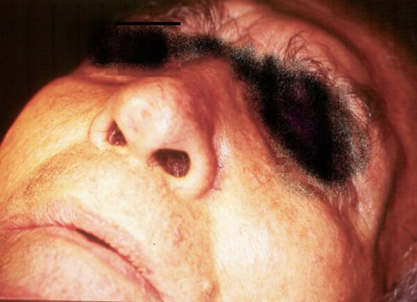 Fig. 1: Nótese asimetría facial
