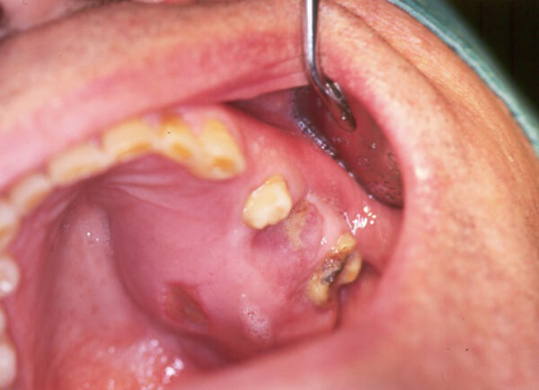 Fig. 2: Imagen clínica intrabucal