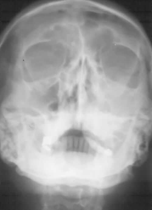 Fig. 4: Radiografía Water.