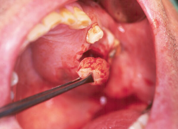 Fig. 6: Imagen clínica con abordaje quirúrgico. Toma de biopsia.