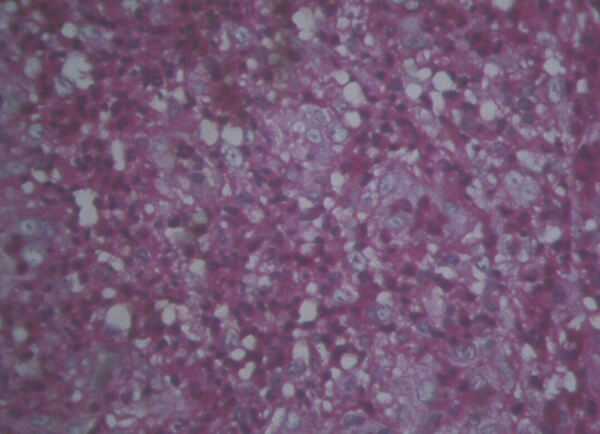 Fig. 7: Imagen histopatológica del tumor. X40. Coloración de PAS.