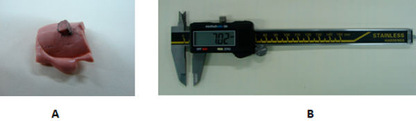 Figura 4 A. Detalle del material de impresión polimerizado retirado de una de las proyecciones de la base metálica. B. Calibrador electrónico.
