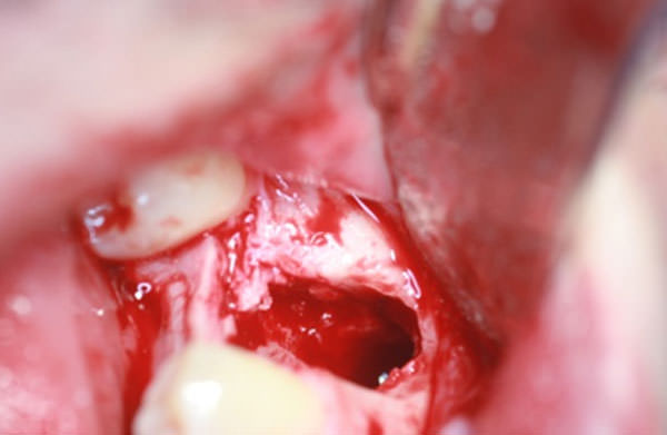 Figura 7 Odontectomia