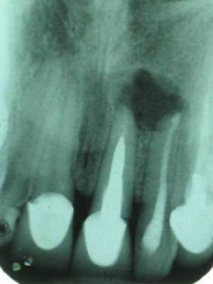 Figura 2 Lesión radiolúcida que compromete los ápices radiculares de ambos dientes, sobre-obturación del incisivo lateral y desadaptación cervicodistal de la corona.
