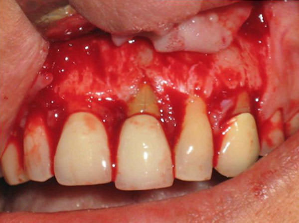 Figura 3 FRV en incisivo central a nivel del eje longitudinal que coincide con la pérdida de hueso alveolar vestibular.