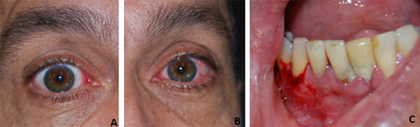 Figura 1 A: enrojecimiento e irritación ocular; B: sangramiento espontáneo y desprendimiento de la encía adherida inferior.