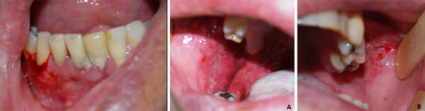 Figura 2 – A: exulceraciones eritematosas en la mucosa yugal del lado derecho; B: exulceraciones eritematosas en la mucosa yugal del lado izquierdo.