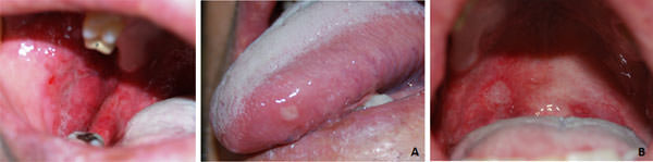 Figura 3 A: vesícula con sintomatología dolorosa en el borde lateral de la lengua; B: áreas de exulceración y ulceración en el paladar blando y orofaringe.