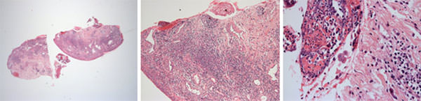 Figura 4 Tejido conjuntivo submucoso infiltrado por células inflamatorias mono y polimorfonucleares. Presencia de eosinófilos. En la superficie, exudado serofibrinoso y recubrimiento epitelial de células basales de forma desorganizada. En algunos locales presencia de células Tzank.