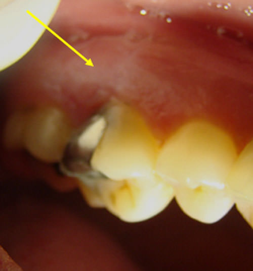 Figura 2 Vista intrabucal de lesión blanca, no removible, de textura lisa, localizada en la encía vestibular adyacente a los dientes 16 y 17.