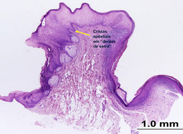 Figura 3 Corte histológico de fragmento de lesión en la mucosa bucal. Se observa la presencia de crestas epiteliales en forma de "dientes de sierra", característica encontrada en las lesiones liquenoides.