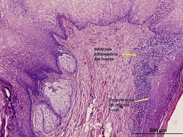 Figura 4 Corte histológico de fragmento de lesión en la mucosa bucal. Presencia de infiltrado inflamatorio crónico en banda asociado a degeneración de la capa basal.
