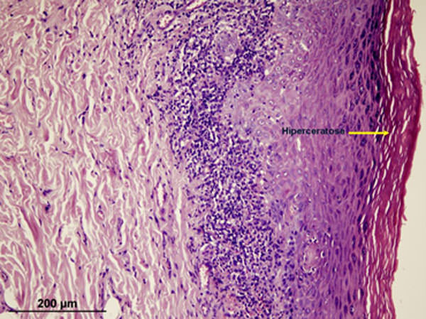 Figura 5 Corte histológico de fragmento de lesión en la mucosa bucal. Se observa hiperqueratosis del tejido y la capa granulosa bien evidente.