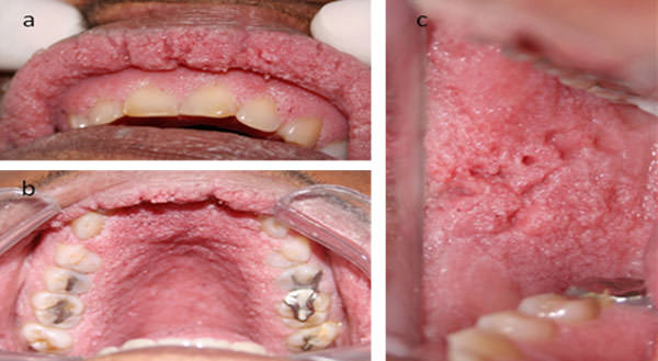 Fig.1 Papilomatosis oral múltiple. A mucosa labial, B paladar duro, C mucosa bucal de carrillo derecho.