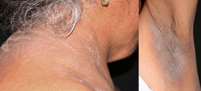 Fig. 2 Hiperqueratosis e hiperpigmentacion región lateral del cuello y axila.