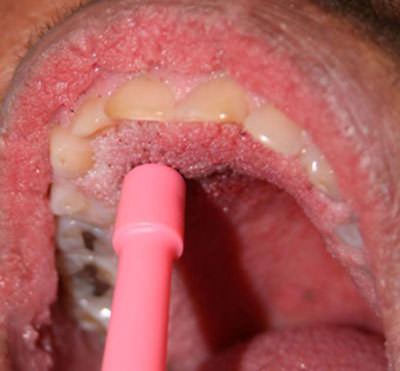 Fig. 3 Biopsia con Punch dermatológico en zona del paladar duro.