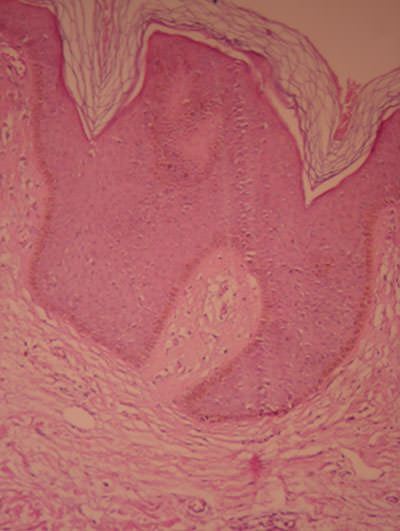 Fig.4 Imagen histológica que muestra papilomatosis e Hiperqueratosis, sin alteraciones en dermis papilar, ni reticular.