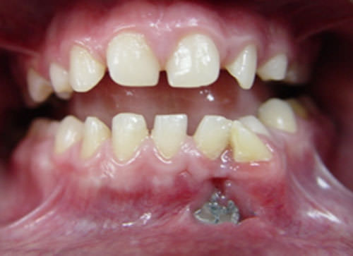 Foto Clínica 1 Foto clínica intrabucal Paciente A
