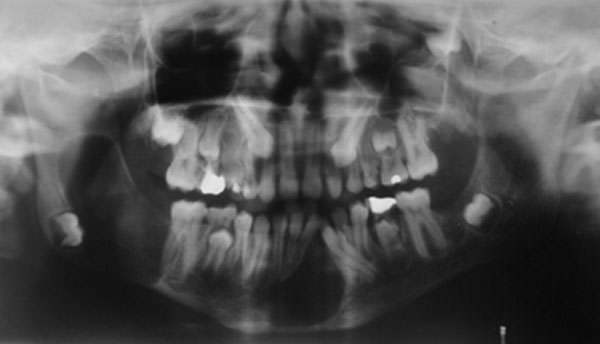 Imagen 1 Rx Panorámica inicial Paciente A