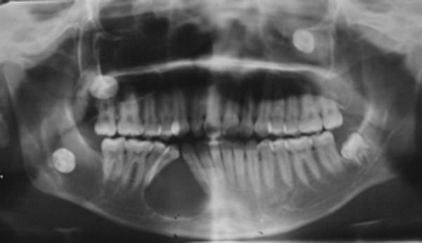 Imagen 3 Rx Panorámica inicial Paciente B