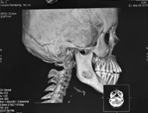 Imagen 4 Tomografía 3D Paciente B