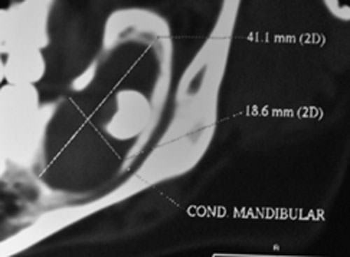 Imagen 5 Detalle de TAC Paciente B