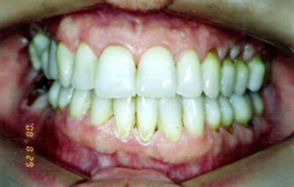 Figura 2 Aspectos clínicos de la cavidad bucal (examen fotográfico frontal)