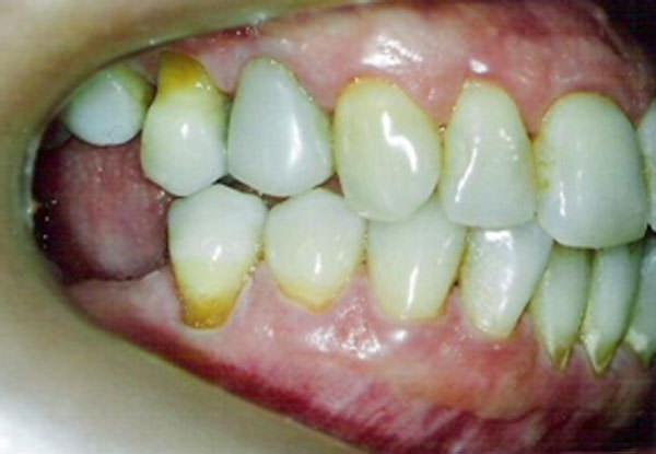 Figura 3 Aspecto clínico de la cavidad bucal (examen fotográfico lateral derecho)