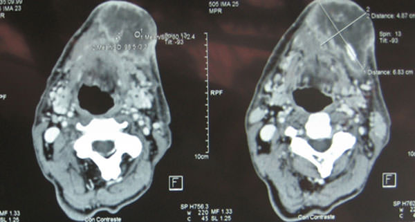 Figura 2 Diagnóstico aumento de volumen de las partes blandas que compromete el piso de boca con una zona hipodensa que corresponde a una colección submandibular izquierda, no se observa imágenes de osteomielitis
