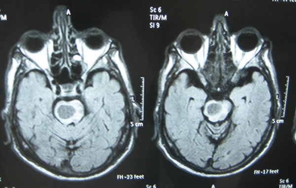 Figura 3 Muestra absceso protuberancial no piogénico