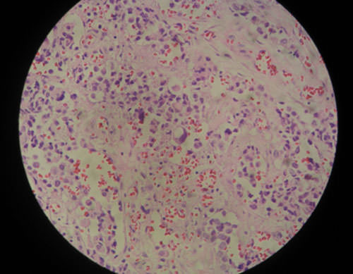Figura 4 Areas de necrosis y hemorragias con amplio infiltrado inflamatorio agudo, bordes quirúrgicos positivos, tumor maligno indiferenciado y ulcerado, compromete bordes quirúrgicos, sugiere Carcinoma o Metástasis.