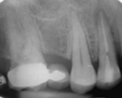 Figura 1 Fotografía de primer premolar obturado se observa lesión apical