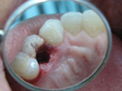 Figura 2 Fotografía post exodoncia de raíz palatina el primer premolar se observa alvéolo y raíz vestibular