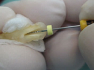 Figura 3 Conductometría extraoral de raíz palatina lima acero # 20