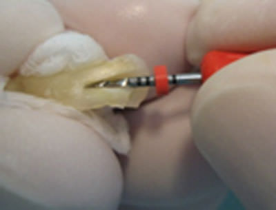Figura 4 Instrumentación extraoral de conducto palatino con limas Protaper® manuales