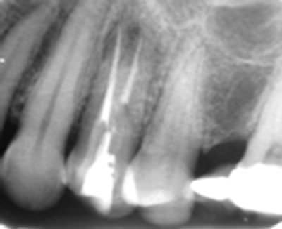 Figura 5 Radiografía raíz palatina reimplantada con tratamiento endodóntico terminado