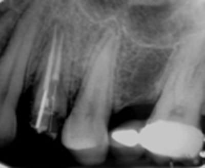Figura 6 Radiografía control 6 meses se observa disminución de lesión apical, recuperación de trabeculado óseo y continuidad del ligamento periodontal