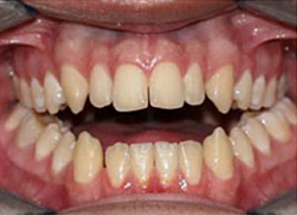 Figura 1 Mordida abierta anterior